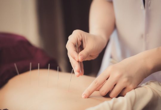 Acupuntura fisioterapia