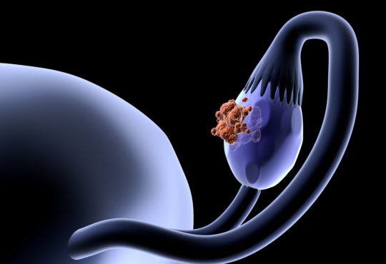 Ovary cancer