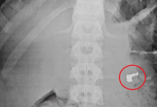 Raio x engoliu joia