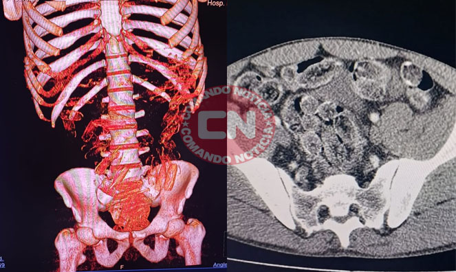 Bolivianos drogas estomago itu