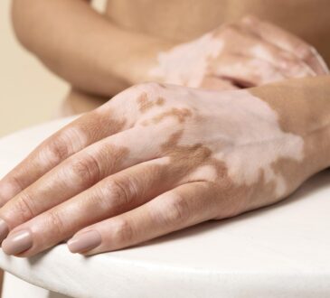 Vitiligo ayfa