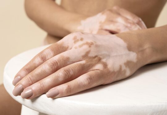 Vitiligo ayfa