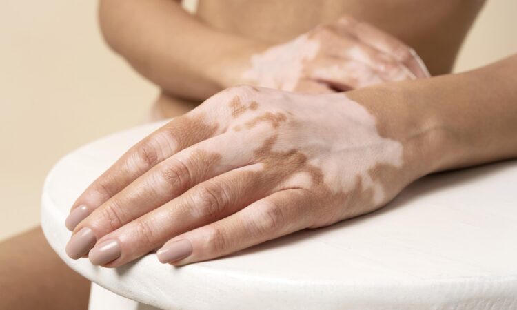 Vitiligo ayfa