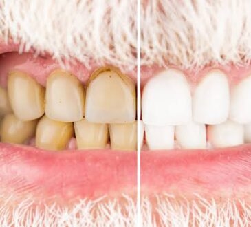 Cigarro afeta os dentes