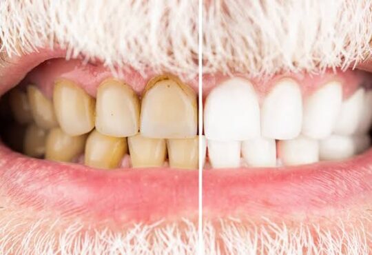 Cigarro afeta os dentes