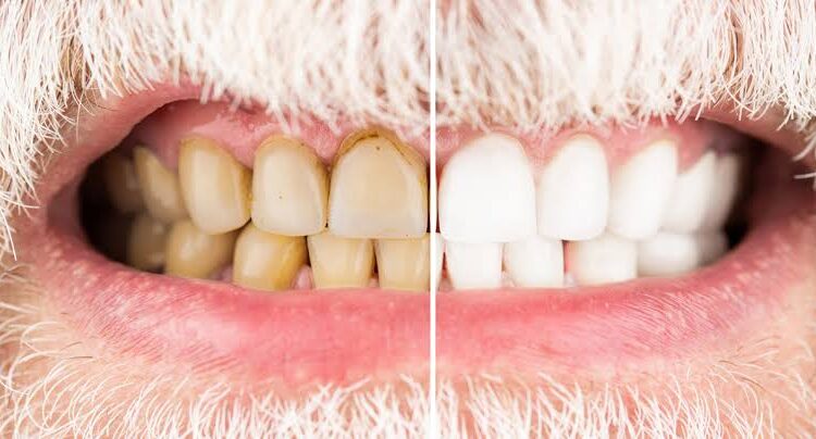 Cigarro afeta os dentes